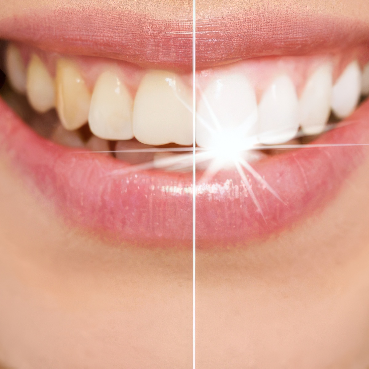 Kosmetyczne wybielanie zębów | Rzeszów